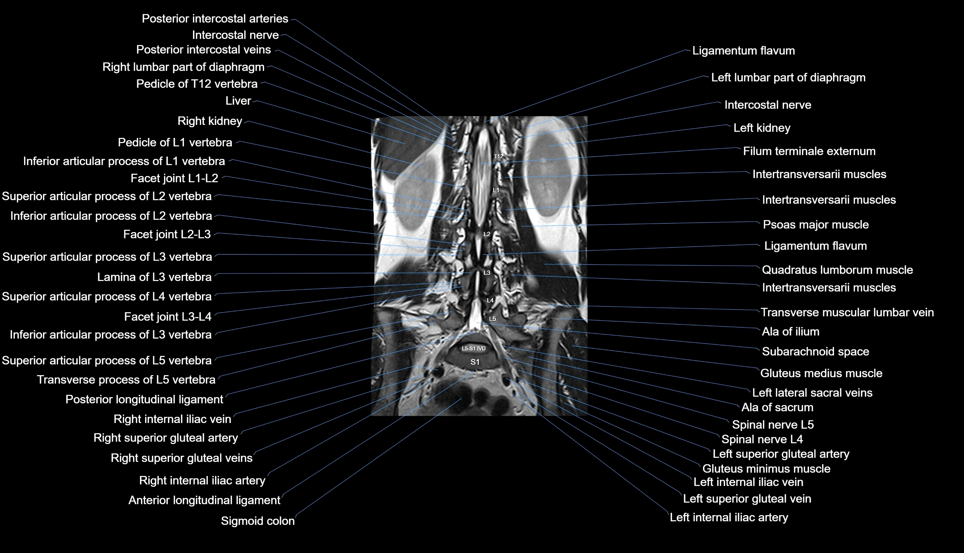 MRI lumbar spine labelled coronal cross sectional anatomy 3T radiology-img-00001-00021.webp